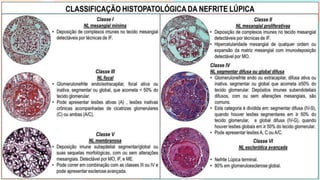 DOENÇAS SISTÊMICAS – L.E.S
o Depósitos de imunocomplexos circulantes
o Manifestações do L.E.S com ou sem lesão renal
o Biopsia renal: GN mesangial focal /difusa ou nefropatia membranosa
o GN difusa é o padrão mais sombrio
o Anti-DNA, FAN, consumo de complemento
o Tratamento com imunossupressão + citotóxicos prolongado
RAPIDAMENTE PROGRESSIVA / IMUNOCOMPLEXOS
 
