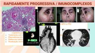 GN PAUCI IMUNE ASSOCIADO AO ANCA
o Pode se limitar aos rins ou associado a vasculopatia sistêmica ( granulomatose de Wegener,
poliarterite nodosa )
o Diagóstico confirmado pela presença do ANCA na imonufluorescencia dos neutrófilos
- Se perinuclear denomia p-ANCA
- Se citoplasmático c-ANCA
- Imunoensaio tipo ELISA direcionado a mieloperoxidade anti MPO e PR3
o Quadro clínico prodômico de síndrome gripal
- Mialgia, astenia, artralgia, febre, perda ponderal
- Alterações cutâneas e respitatórias ou neurológicas
- Capilarite pulmonar e sistêmica
o Tratamento com imunossupressão + drogas citotóxicas e imunibiológico
o Plasmaférese em casos graves e refratários
o Diálise em casos de injúria renal com síndrome azotêmica
o Atualização vacinal
RAPIDAMENTE PROGRESSIVA / IMUNOCOMPLEXOS
 