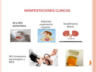 MANIFESTACIONES CLINICAS
40 a 50%
asintomática
Infección
respiratoria
superior
Insuficiencia
Renal
30% hematuria
microscópica y
HTA
 