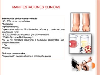 MANIFESTACIONES CLINICAS
Presentación clínica es muy variable:
•40 - 70% : síndrome nefrótico.
• hematuria,
•hipoalbuminemia,
•hipocomplementemia, hiperlipidemias, edema y puede asociarse
insuficiencia renal
•El 30% : proteinuria moderada y/o Microhematuria
•20-30% Sindrome Nefrótico Agudo
•10- 20 %: hematuria recurrente o hematuria asintomática con
cilindros hemáticos
•HTA
•Anemia
Síntomas extrarrenales:
•Degeneración macular retiniana o lipodistrofia parcial
 