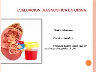 EVALUACION DIAGNOSTICA EN ORINA
Cilindros eritrocitarios
Eritrocitos dismórficos
Proteinuria de grado variable que con
poca frecuencia supera los 3 g/día
 