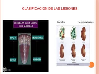 CLASIFICACION DE LAS LESIONES
Focales Segmentarias
 