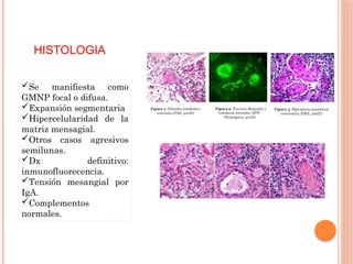 HISTOLOGIA
Se manifiesta como
GMNP focal o difusa.
Expansión segmentaria
Hipercelularidad de la
matriz mensagial.
Otros casos agresivos
semilunas.
Dx definitivo:
inmunofluorecencia.
Tensión mesangial por
IgA.
Complementos
normales.
 