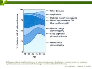 Grafica que evidencia las diferentes formas de enfermedad glomerular, identificadas a través de biopsia con proteinuira
>3gr/d Evaluados en el Laboratorio de Nefropatología de la Universidad de North Carolina.
Brenner & Rector´s The kidney, 7th. Ed, 2004
 