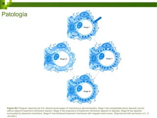 Figure 28-7 Diagram depicting the four ultrastructural stages of membranous glomerulopathy. Stage I has subepithelial dense deposits (arrow)
without adjacent basement membrane reaction. Stage II has projections of basement membrane adjacent to deposits. Stage III has deposits
surrounded by basement membrane. Stage IV has thickened basement membrane with irregular lucent zones. (Reproduced with permission of J. C.
Jennette.)
Patología
 