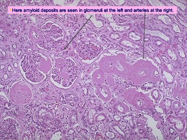 glomerulus and nephrotic nephritic syndrome 40 638