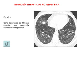 NEUMONÍA INTERSTICIAL NO ESPECÍFICA
Fig. 43.-
Corte transverso de TC que
muestra una neumonía
intersticial no específica.
 