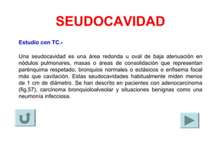 SEUDOCAVIDAD
Estudio con TC.-
Una seudocavidad es una área redonda u oval de baja atenuación en
nódulos pulmonares, masas o áreas de consolidación que representan
parénquima respetado, bronquios normales o ectásicos o enfisema focal
más que cavitación. Estas seudocavidades habitualmente miden menos
de 1 cm de diámetro. Se han descrito en pacientes con adenocarcinoma
(fig.57), carcinoma bronquioloalveolar y situaciones benignas como una
neumonía infecciosa.
 