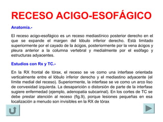 RECESO ACIGO-ESOFÁGICO
Anatomía.-
El receso acigo-esofágico es un receso mediastínico posterior derecho en el
que se expande el margen del lóbulo inferior derecho. Está limitado
superiormente por el cayado de la ácigos, posteriormente por la vena ácigos y
pleura anterior a la columna vertebral y medialmente por el esófago y
estructuras adyacentes.
Estudios con Rx y TC.-
En la RX frontal de tórax, el receso se ve como una interfase orientada
verticalmente entre el lóbulo inferior derecho y el mediastino adyacente (el
límite medial del receso). Superiormente, la interfase se ve como un arco liso
de convexidad izquierda. La desaparición o distorsión de parte de la interfase
sugiere enfermedad (ejemplo, adenopatia subcarinal). En los cortes de TC se
debe prestar atención al receso (fig.9), porque lesiones pequeñas en esa
localización a menudo son invisibles en la RX de tórax
 