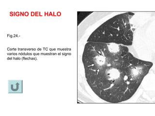 SIGNO DEL HALO
Fig.24.-
Corte transverso de TC que muestra
varios nódulos que muestran el signo
del halo (flechas).
 