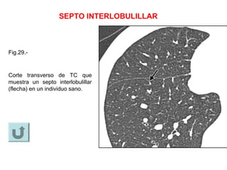 SEPTO INTERLOBULILLAR
Fig.29.-
Corte transverso de TC que
muestra un septo interlobulillar
(flecha) en un individuo sano.
 