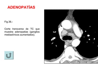 ADENOPATÍAS
Fig.36.-
Corte transverso de TC que
muestra adenopatias (ganglios
mediastínicos aumentados).
 