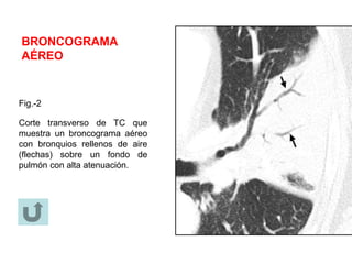 BRONCOGRAMA
AÉREO
Fig.-2
Corte transverso de TC que
muestra un broncograma aéreo
con bronquios rellenos de aire
(flechas) sobre un fondo de
pulmón con alta atenuación.
 