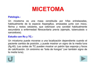 MICETOMA
Patología.-
Un micetoma es una masa constituida por hifas entrelazadas,
habitualmente de la especie Aspergillus, amasadas junto con moco,
fibrina y restos celulares, que colonizan una cavidad habitualmente
secundaria a enfermedad fibrocavitaria previa (ejemplo, tuberculosis o
sarcoidosis).
Estudio con Rx y TC.-
Un micetoma puede moverse a una localización dependiente cuando el
paciente cambia de posición, y puede mostrar un signo de la media luna
(fig.40). Los cortes de TC pueden mostrar un patrón tipo esponja y focos
de calcificación. Un sinónimo es “bola de hongos” (ver también signo de
la media luna).
 