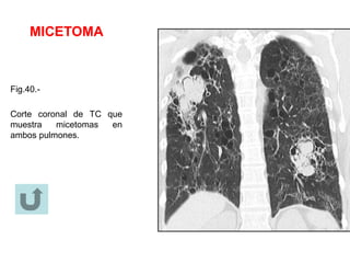 MICETOMA
Fig.40.-
Corte coronal de TC que
muestra micetomas en
ambos pulmones.
 