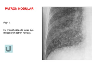 PATRÓN NODULAR
Fig.41.-
Rx magnificada de tórax que
muestra un patrón nodular.
 