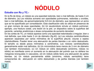 NÓDULO
Estudio con Rx y TC.-
En la Rx de tórax, un nódulo es una opacidad redonda, bien o mal definida, de hasta 3 cm
de diámetro. (a) Los nódulos acinares son opacidades pulmonares, redondas u ovoides,
bien o mal definidas, de aproximadamente 5-8 mm de diámetro, que representan un acino
que se ha opacificado por consolidación. Esta clasificación sólo se utiliza en presencia de
un gran número de esas opacidades. (b) Un seudonódulo simula un nódulo pulmonar;
ejemplo, una fractura costal, una lesión en la piel, un dispositivo sobre la superficie del
paciente, variantes anatómicas o áreas compuestas de aumento densidad.
En los cortes de TC, un nódulo aparece como una opacidad redondeada o irregular, bien o
mal definida, que mide hasta 3 cm de diámetro (fig.42). (a) Los nódulos centrilobulillares
aparecen separados por varios milímetros de la superficie pleural, cisuras o septos
interlobulillares. Pueden tener una atenuación de partes blandas o en vidrio deslustrado.
El tamaño va desde pocos milímetros a centimetros. Los nódulos centrilobulillares
generalmente están mal definidos. (b) Un micronódulo tiene menos de 3 mm de diámetro
(ver tambien micronodulo). (c) Un nódulo en vidrio deslustrado (sinónimo, nódulo no
sólido) se manifiesta como un aumento en la atenuación del pulmón que no oblitera los
márgenes bronquiales ni vasculares. (d) Un nódulo sólido tiene una atenuación de partes
blandas. (e) Un nódulo parcialmente sólido (sinónimo, nódulo semisólido) tiene
componentes de atenuación en vidrio deslustrado y de partes blandas (ver también
masa).
 