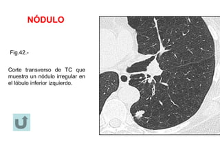 NÓDULO
Fig.42.-
Corte transverso de TC que
muestra un nódulo irregular en
el lóbulo inferior izquierdo.
 