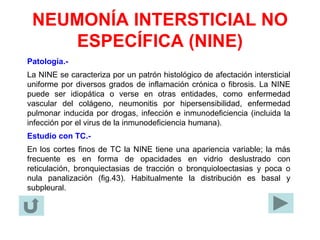 NEUMONÍA INTERSTICIAL NO
ESPECÍFICA (NINE)
Patología.-
La NINE se caracteriza por un patrón histológico de afectación intersticial
uniforme por diversos grados de inflamación crónica o fibrosis. La NINE
puede ser idiopática o verse en otras entidades, como enfermedad
vascular del colágeno, neumonitis por hipersensibilidad, enfermedad
pulmonar inducida por drogas, infección e inmunodeficiencia (incluida la
infección por el virus de la inmunodeficiencia humana).
Estudio con TC.-
En los cortes finos de TC la NINE tiene una apariencia variable; la más
frecuente es en forma de opacidades en vidrio deslustrado con
reticulación, bronquiectasias de tracción o bronquioloectasias y poca o
nula panalización (fig.43). Habitualmente la distribución es basal y
subpleural.
 
