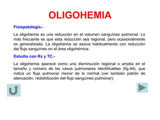OLIGOHEMIA
Fisiopatología.-
La oligohemia es una reducción en el volumen sanguíneo pulmonar. Lo
más frecuente es que esta reducción sea regional, pero ocasionalmente
es generalizada. La oligohemia se asocia habitualmente con reducción
del flujo sanguíneo en el área oligohémica.
Estudio con Rx y TC.-
La oligohemia aparece como una disminución regional o amplia en el
tamaño y número de los vasos pulmonares identificables (fig.44), que
indica un flujo pulmonar menor de lo normal (ver también patrón de
atenuación, redistribución del flujo sanguíneo pulmonar).
 