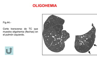 OLIGOHEMIA
Fig.44.-
Corte transverso de TC que
muestra oligohemia (flechas) en
el pulmón izquierdo.
 