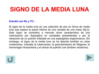 SIGNO DE LA MEDIA LUNA
Estudio con Rx y TC.-
El signo de la media luna es una colección de aire en forma de media
luna que separa la pared interna de una cavidad de una masa (fig.3).
Este signo se considera a menudo como característico de una
colonización por Aspergillus en cavidades preexistentes o por la
retracción de un pulmón infartado en una aspergilosis angioinvasiva. Sin
embargo, el signo de la media luna se ha descrito también en otras
condiciones, incluidas la tuberculosis, la granulomatosis de Wegener, la
hemorragia intracavitaria y el cáncer de pulmón (ver tambien micetoma).
 