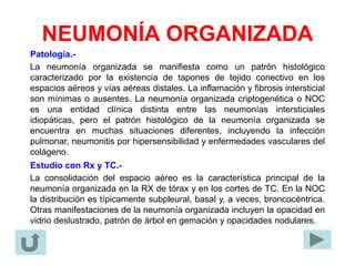 NEUMONÍA ORGANIZADA
Patología.-
La neumonía organizada se manifiesta como un patrón histológico
caracterizado por la existencia de tapones de tejido conectivo en los
espacios aéreos y vías aéreas distales. La inflamación y fibrosis intersticial
son mínimas o ausentes. La neumonía organizada criptogenética o NOC
es una entidad clínica distinta entre las neumonías intersticiales
idiopáticas, pero el patrón histológico de la neumonía organizada se
encuentra en muchas situaciones diferentes, incluyendo la infección
pulmonar, neumonitis por hipersensibilidad y enfermedades vasculares del
colágeno.
Estudio con Rx y TC.-
La consolidación del espacio aéreo es la característica principal de la
neumonía organizada en la RX de tórax y en los cortes de TC. En la NOC
la distribución es típicamente subpleural, basal y, a veces, broncocéntrica.
Otras manifestaciones de la neumonía organizada incluyen la opacidad en
vidrio deslustrado, patrón de árbol en gemación y opacidades nodulares.
 
