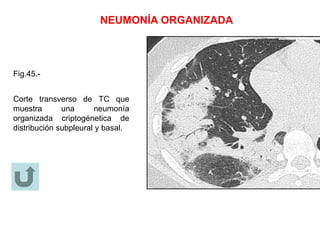 NEUMONÍA ORGANIZADA
Fig.45.-
Corte transverso de TC que
muestra una neumonía
organizada criptogénetica de
distribución subpleural y basal.
 