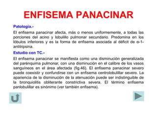 ENFISEMA PANACINAR
Patología.-
El enfisema panacinar afecta, más o menos uniformemente, a todas las
porciones del acino y lobulillo pulmonar secundario. Predomina en los
lóbulos inferiores y es la forma de enfisema asociada al déficit de α-1-
antitripsina.
Estudio con TC.-
El enfisema panacinar se manifiesta como una disminución generalizada
del parénquima pulmonar, con una disminución en el calibre de los vasos
sanguíneos en el área afectada (fig.46). El enfisema panacinar severo
puede coexistir y confundirse con un enfisema centrolobulillar severo. La
apariencia de la disminución de la atenuación puede ser indistinguible de
la bronquiolitis obliterante constrictiva severa. El término enfisema
panlobulillar es sinónimo (ver también enfisema).
 