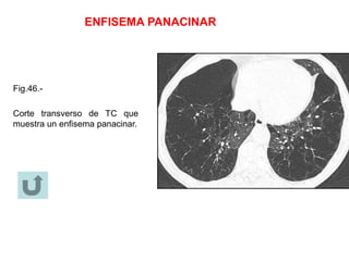 ENFISEMA PANACINAR
Fig.46.-
Corte transverso de TC que
muestra un enfisema panacinar.
 