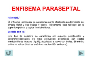 ENFISEMA PARASEPTAL
Patología.-
El enfisema paraseptal se caracteriza por la afectación predominante del
alveolo distal y sus ductus y sacos. Típicamente está rodeado por la
superficie pleural y septos interlobulillares.
Estudio con TC.-
Este tipo de enfisema se caracteriza por regiones subpleurales y
peribroncovasculares de baja atenuación separadas por septos
interlobulillares intactos (fig.47), asociadas a veces con bullas. El término
enfisema acinar distal es sinónimo (ver también enfisema).
 