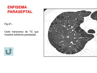 ENFISEMA
PARASEPTAL
Fig.47.-
Corte transverso de TC que
muestra enfisema paraseptal.
 