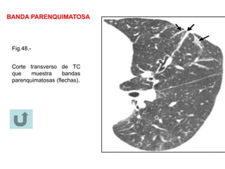 BANDA PARENQUIMATOSA
Fig.48.-
Corte transverso de TC
que muestra bandas
parenquimatosas (flechas).
 