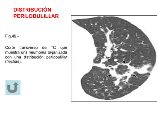 DISTRIBUCIÓN
PERILOBULILLAR
Fig.49.-
Corte transverso de TC que
muestra una neumonía organizada
con una distribución perilobulillar
(flechas).
 