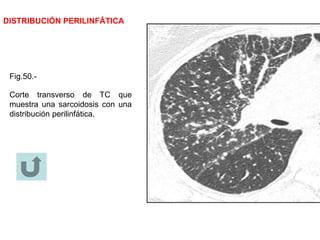 DISTRIBUCIÓN PERILINFÁTICA
Fig.50.-
Corte transverso de TC que
muestra una sarcoidosis con una
distribución perilinfática.
 