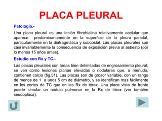 PLACA PLEURAL
Patología.-
Una placa pleural es una lesión fibrohialina relativamente acelular que
aparece predominantemente en la superficie de la pleura parietal,
particularmente en la diafragmática y subcostal. Las placas pleurales son
casi invariablemente la consecuencia de exposición previa al asbesto (por
lo menos 15 años antes).
Estudio con Rx y TC.-
Las placas pleurales son áreas bien delimitadas de engrosamiento pleural;
se ven como lesiones planas elevadas o nodulares que, a menudo,
contienen calcio (fig.51). Las placas son de grosor variable, con un rango
de menos de 1 a unos 5 cm de diámetro, y se identifican mas fácilmente
en los cortes de TC que en las Rx de tórax. Una placa vista de frente
puede simular un nódulo pulmonar en la Rx de tórax (ver también
seudoplaca).
 