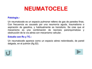 NEUMATOCELE
Patología.-
Un neumatocele es un espacio pulmonar relleno de gas de paredes finas.
Con frecuencia es causado por una neumonía aguda, traumatismo o
aspiración de gasolina, y habitualmente es transitorio. Se cree que el
mecanismo es una combinación de necrosis parenquimatosa y
obstrucción de la vía aérea con mecanismo valvular.
Estudio con Rx y TC.-
Un neumatocele aparece como un espacio aéreo redondeado, de pared
delgada, en el pulmón (fig.52).
 