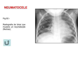 NEUMATOCELE
Fig.52.-
Radiografia de tórax que
muestra un neumatocele
(flechas).
 