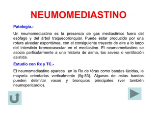NEUMOMEDIASTINO
Patología.-
Un neumomediastino es la presencia de gas mediastínico fuera del
esófago y del árbol traqueobronquial. Puede estar producido por una
rotura alveolar espontánea, con el consiguiente trayecto de aire a lo largo
del intersticio broncovascular en el mediastino. El neumomediastino se
asocia particularmente a una historia de asma, tos severa o ventilación
asistida.
Estudio con Rx y TC.-
El neumomediastino aparece en la Rx de tórax como bandas lúcidas, la
mayoría orientadas verticalmente (fig.53). Algunas de estas bandas
pueden delimitar vasos y bronquios principales (ver también
neumopericardio).
 