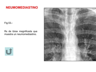 NEUMOMEDIASTINO
Fig.53.-
Rx de tórax magnificada que
muestra un neumomediastino.
 