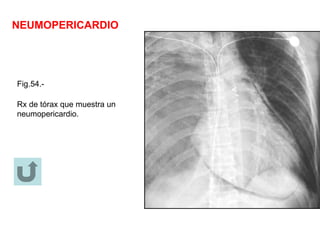 NEUMOPERICARDIO
Fig.54.-
Rx de tórax que muestra un
neumopericardio.
 