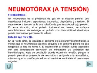 NEUMOTÓRAX (A TENSIÓN)
Fisiopatología.-
Un neumotórax es la presencia de gas en el espacio pleural. Los
descriptores incluyen: espontáneo, traumático, diagnóstico y a tensión. El
neumotórax a tensión es la acumulación de gas intrapleural bajo presión.
En esta situación, si el pulmón ipsilateral es normal, se colapsa
completamente; sin embargo, un pulmón con distensibilidad disminuida
puede permanecer parcialmente inflado.
Estudio con Rx y TC.-
En la Rx de tórax, se visualiza el contorno de la pleural visceral (fig.55), a
menos que el neumotórax sea muy pequeño o el contorno pleural no sea
tangencial al haz de rayos x. El neumotórax a tensión puede asociarse
con una considerable desviación del mediastino y/o depresión del
hemidiafragma. Algo de desviación puede ocurrir sin tensión, porque la
presión pleural en presencia de neumotórax se iguala a la atmosférica,
mientras que la presión pleural en el hemitórax contralateral permanece
negativa.
 