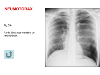 NEUMOTÓRAX
Fig.55.-
Rx de tórax que muestra un
neumotórax.
 
