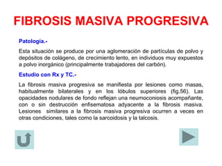 FIBROSIS MASIVA PROGRESIVA
Patología.-
Esta situación se produce por una aglomeración de partículas de polvo y
depósitos de colágeno, de crecimiento lento, en individuos muy expuestos
a polvo inorgánico (principalmente trabajadores del carbón).
Estudio con Rx y TC.-
La fibrosis masiva progresiva se manifiesta por lesiones como masas,
habitualmente bilaterales y en los lóbulos superiores (fig.56). Las
opacidades nodulares de fondo reflejan una neumoconiosis acompañante,
con o sin destrucción enfisematosa adyacente a la fibrosis masiva.
Lesiones similares a la fibrosis masiva progresiva ocurren a veces en
otras condiciones, tales como la sarcoidosis y la talcosis.
 