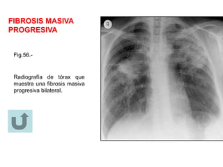 FIBROSIS MASIVA
PROGRESIVA
Fig.56.-
Radiografía de tórax que
muestra una fibrosis masiva
progresiva bilateral.
 