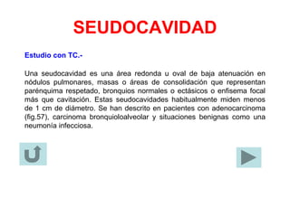 SEUDOCAVIDAD
Estudio con TC.-
Una seudocavidad es una área redonda u oval de baja atenuación en
nódulos pulmonares, masas o áreas de consolidación que representan
parénquima respetado, bronquios normales o ectásicos o enfisema focal
más que cavitación. Estas seudocavidades habitualmente miden menos
de 1 cm de diámetro. Se han descrito en pacientes con adenocarcinoma
(fig.57), carcinoma bronquioloalveolar y situaciones benignas como una
neumonía infecciosa.
 