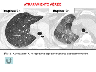 ATRAPAMIENTO AÉREO
Inspiración Espiración
Fig.- 4 Corte axial de TC en inspiración y espiración mostrando el atrapamiento aéreo.
Inspiración Espiración
 