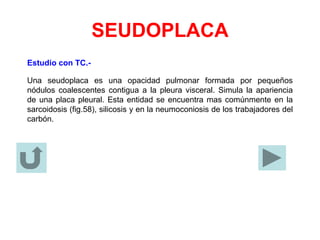 SEUDOPLACA
Estudio con TC.-
Una seudoplaca es una opacidad pulmonar formada por pequeños
nódulos coalescentes contigua a la pleura visceral. Simula la apariencia
de una placa pleural. Esta entidad se encuentra mas comúnmente en la
sarcoidosis (fig.58), silicosis y en la neumoconiosis de los trabajadores del
carbón.
 