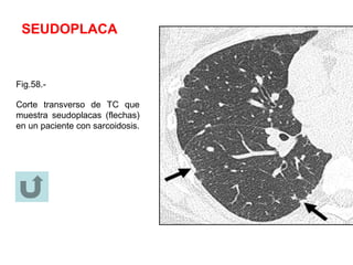 SEUDOPLACA
Fig.58.-
Corte transverso de TC que
muestra seudoplacas (flechas)
en un paciente con sarcoidosis.
 