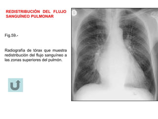 REDISTRIBUCIÓN DEL FLUJO
SANGUÍNEO PULMONAR
Fig.59.-
Radiografía de tórax que muestra
redistribución del flujo sanguíneo a
las zonas superiores del pulmón.
 